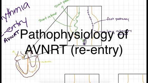 Pathophysiology Of AVNRT YouTube