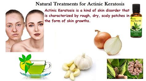 Actinic Keratosis Natural Treatment For Actinic Keratosis A Skin