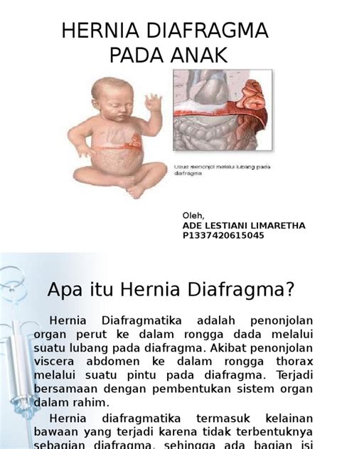Hernia Diafragma Pdf