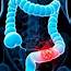 Early Detection Of Colorectal Cancer  Novigenix