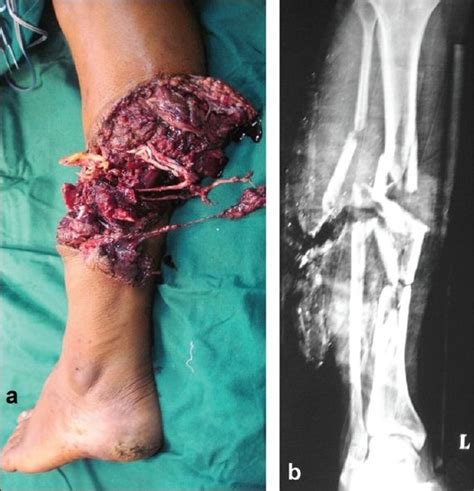 A Clinical Photograph Of Leg With Severe Crushing Of Soft Tissues
