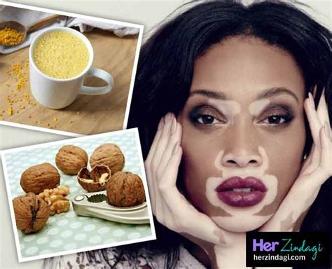 These Home Remedies Can Cure Vitiligo Easily