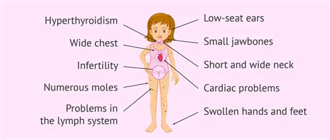 What Is Turner Syndrome Its Causes Characteristics And Pregnancy