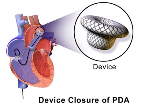 Pda Device Closure Congenital Heart Desk Foundation Bangladesh