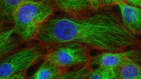 New Insights Reveal How Breast Cancer Cells Survive In Lymph Nodes