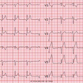 Patient 1 Initial 12 Lead ECG Showing Sinus Rhythm At 66 Bpm With An