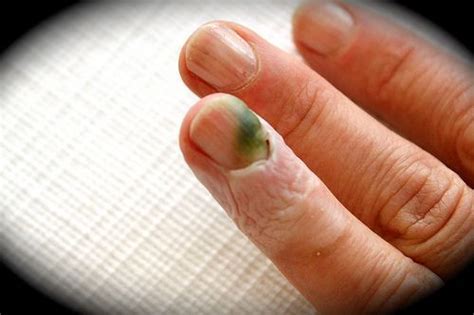 Finger Nail Fungus Check More At Nail