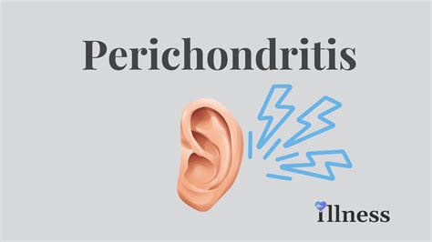 Perichondritis Overview Causes Symptoms Treatment