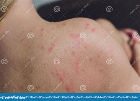 Close Up Allergy Rash Around Back View Of Human With Dermatitis