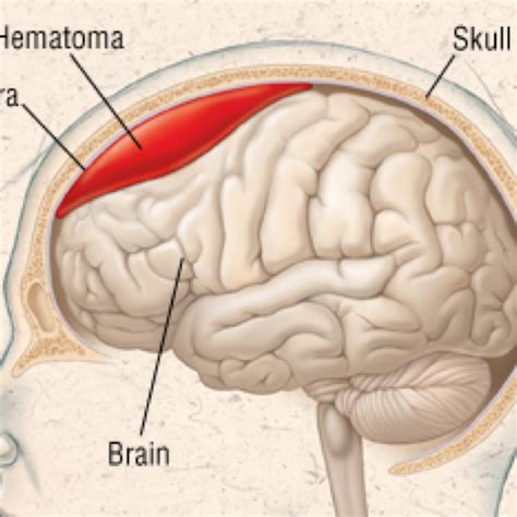Subdural Hematoma Subdural Hematoma Medical Knowledge Neurology Gambaran
