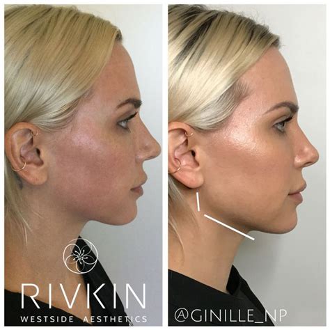 Non Surgical Jawline Contouring The Procedure For A More Defined And