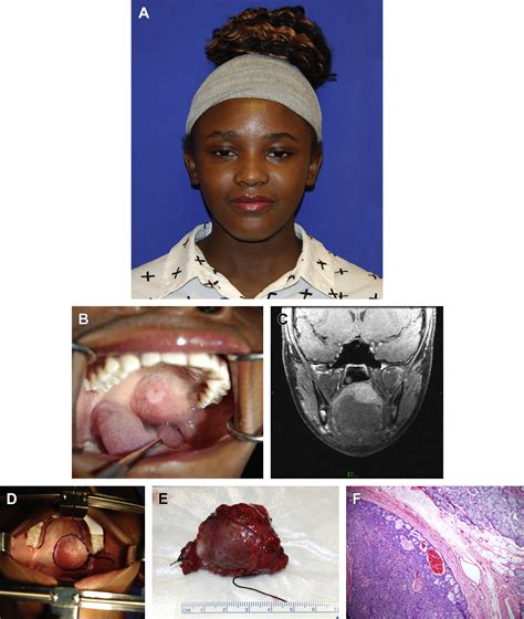 Benign Pediatric Salivary Gland Lesions Oral And Maxillofacial