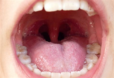 Infected Tonsil Stones