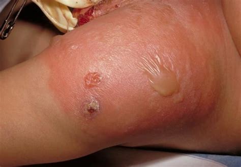 No cellulitis no elevation in wbc count no bacteria or wbcs present in fluid (serous fluid contained within the cyst). Cellulitis - Pictures, Symptoms, Treatment, Contagious ...
