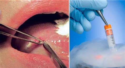 Oral Biopsy Avant Dental