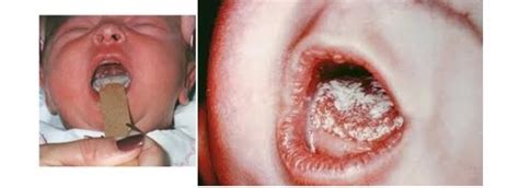 Cara ini dikatakan mampu menghilangkan ulser dalam mulut yang menyebabkan ketidakselesaan dan rasa sangat pedih. Jangkitan Kulat Pada Mulut Bayi