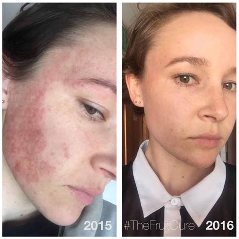 Eczema Before And After