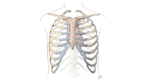 Sternal Precautions Following Open Heart Surgery Pulse Cardiac Health