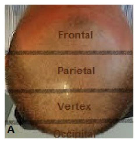 Photos Demonstrating The Division Of The Scalp In Four Halves Frontal