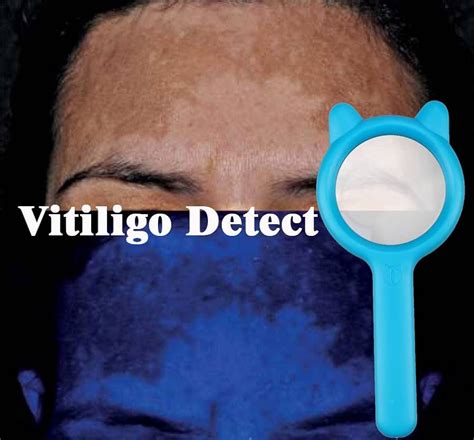 Image Vitiligo Observé à La Lampe De Wood Manuels Msd Pour Le Grand