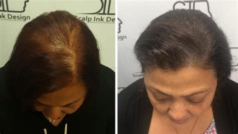 Scalp Micropigmentation For Women Conceal Hair Loss And Thinning Hair