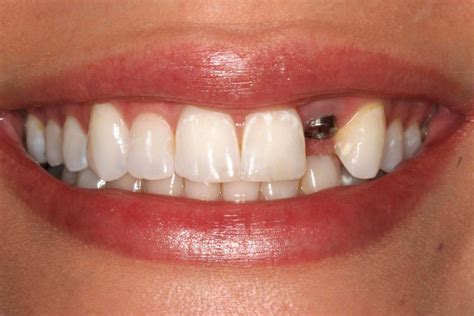 Tek Diş İmplant İmplant Diş İmplant Tedavisi İmplant Fiyatları