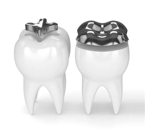 Inlays And Onlays The Conservative Tooth Restoration Tc Dental Group