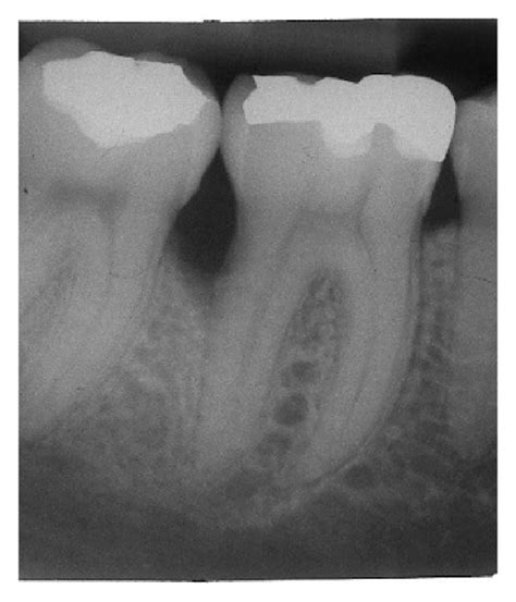 Clinical Photographs A B And Radiographic Images Of Teeth 46 C D