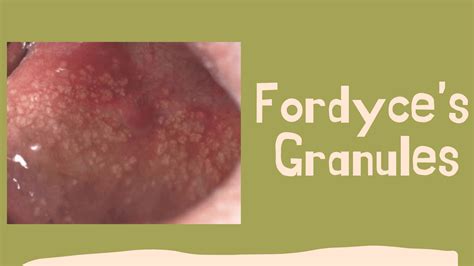 Fordyces Granules Dental Pockets Blog