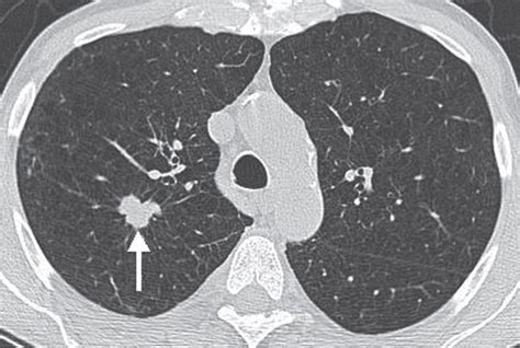 Ct Scan Shows Small Nodule On Lung Ct Scan Machine