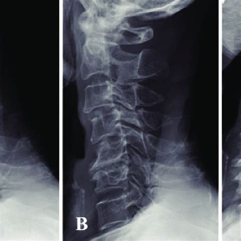 Case 7 Preoperative Radiographs Of The Cervical Spine X P Lateral