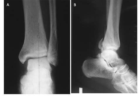 Figure From Irreducible Ankle Fractures By Locked Posterior Malleolar Fragment Case Report