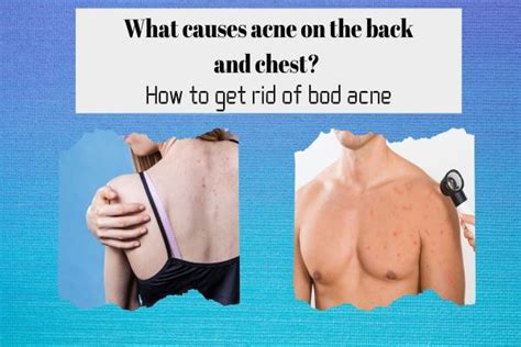 What Causes Acne On The Back And Chest How To Get Rid Of Body Acne