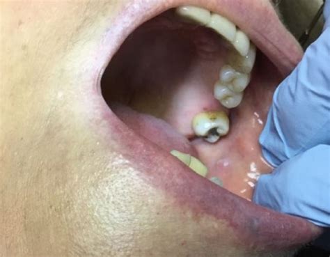 Derm Dx A Bothersome Lesion Of The Buccal Mucosa Clinical Advisor