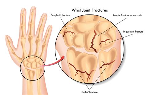Elderly Wrist Fractures Causes And Treatment Options