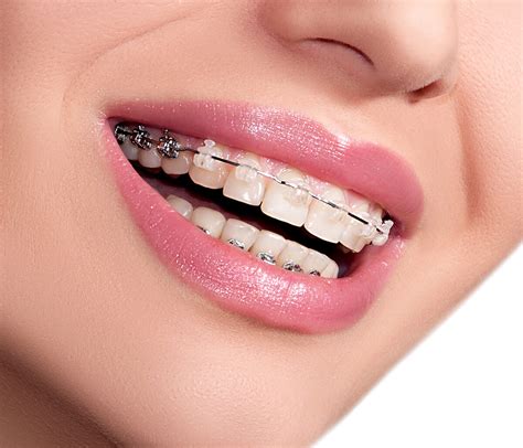 The Process Of Getting Clear Braces In Mission Viejo