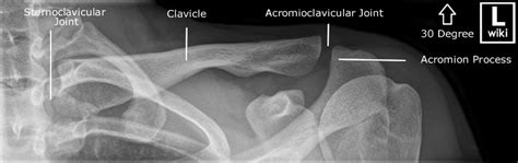 Clavicle Radiographic Anatomy Wikiradiography