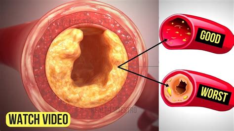 Just 3 Ingredients Will Unclog Your Arteries Without Medication And