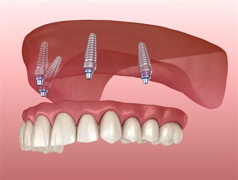 Dental Implants And Implant Fixed Dentures Tulsa Precision Dental