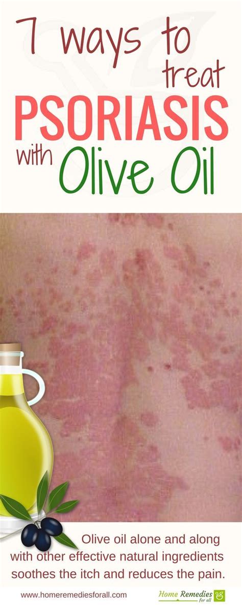 Use Olive Oil As Psoriasis Home Remedy Psoriasis Remedies Home