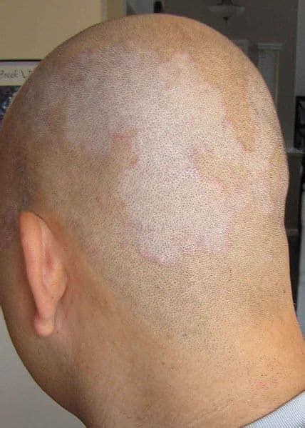 On Dandruff Seborrhoeic Dermatitis Head Shaving And Permanent Hair