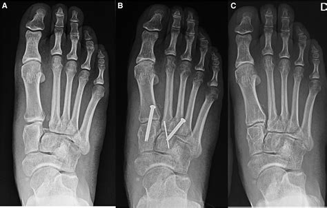 References In Lisfranc Joint Ligament Complex Reconstruction A
