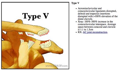 Complete separation (grades 3, 4, 5, and 6) initial symptoms. Acromioclavicular Joint Separations S43.109A 831.04 | eORIF