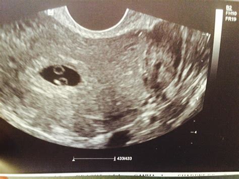 Identical Twins Ultrasound 6 Weeks 6 Weeks Pregnant With Twins Update
