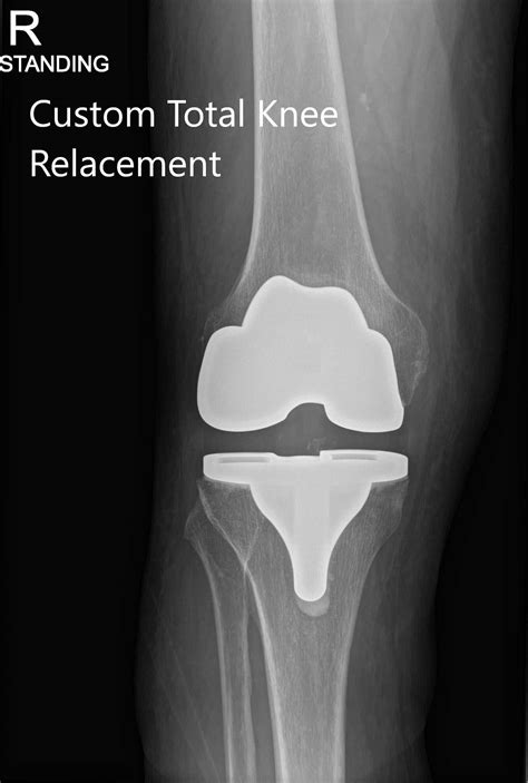 Case Study Unilateral Knee Replacement In 74 Yr Old Female