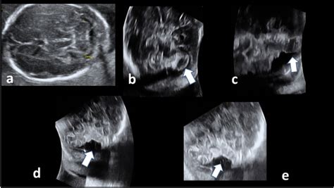 Case M5 C5 Longitudinal Ultrasound Examination Of Fetal Cerebellar