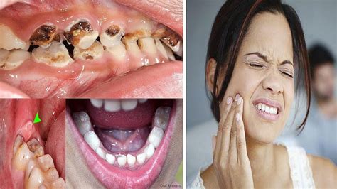 5 Home Remedies To Kill Tooth Pain Nerve Quickly Youtube