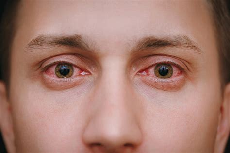 Why Does Weed Make Your Eyes Red Clearbrook Treatment Centers