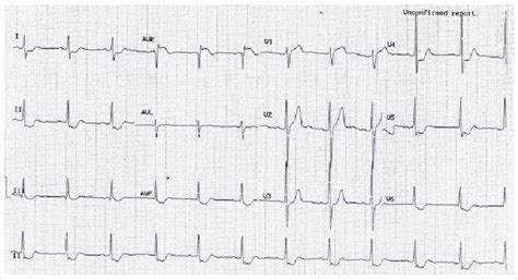 Ecg Showing St Elevation In Avr V1 With Upright T Wave In Lead Avl
