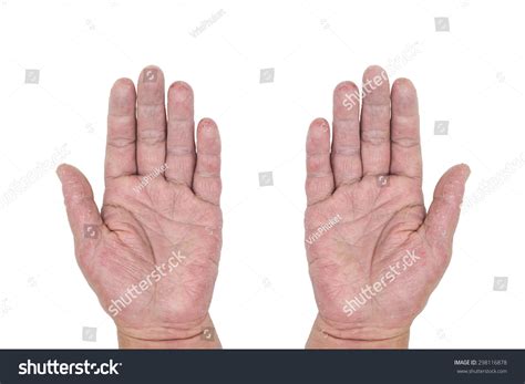 Male Palms Eczema Isolated On White Stock Photo 298116878 Shutterstock